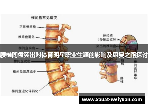 腰椎间盘突出对体育明星职业生涯的影响及康复之路探讨